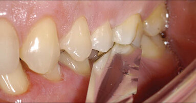 Artikulační papíry a tipy pro kontrolu okluze: klinické tipy pro vypořádání se s okluzními kontakty