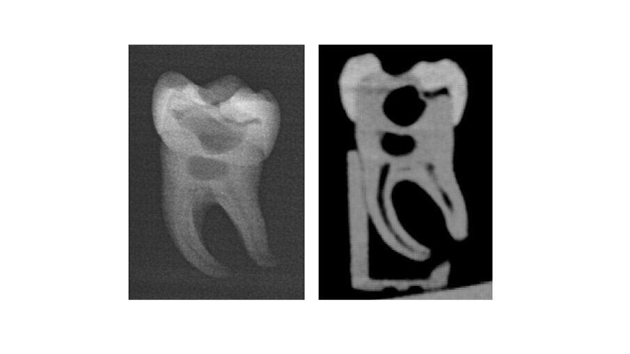 3D-printed teeth improve endodontic training_4