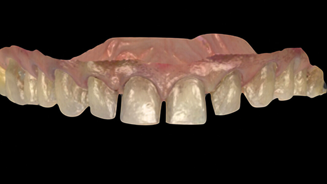 Fig. 11. Impresión digital con TRIOS.