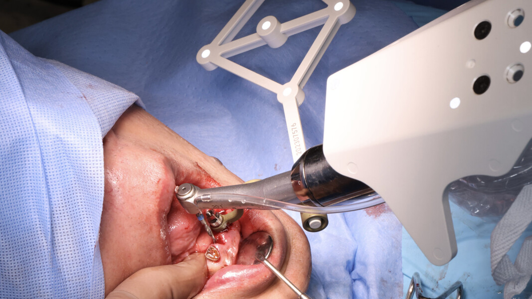 Fig. 9: Robot-mounted surgical handpiece during flapless osteotomy preparation at site #42. Optical tracking array stabilised in the mandible by the fixation screw.