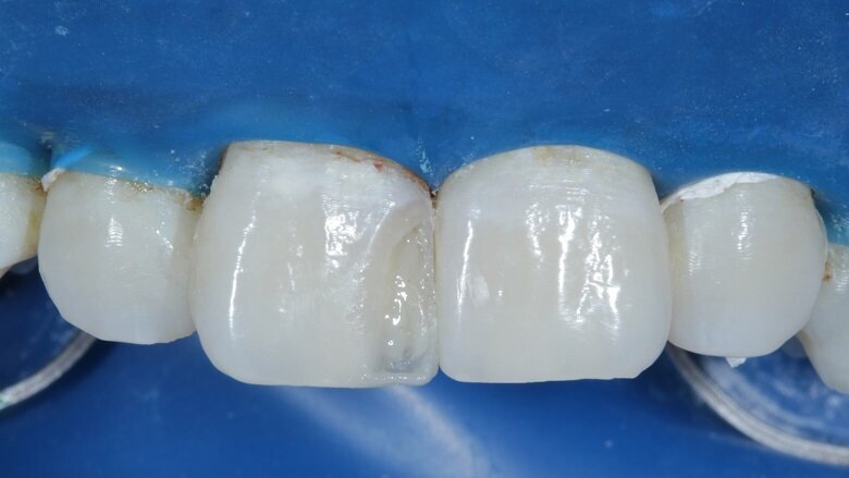 Fig 16: Dentin layer