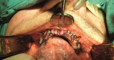 Rekonstrukcja implantoprotetyczna bezzębia szczęki