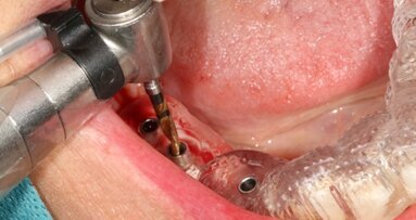 Pourquoi avoir recours à un guide chirurgical pour placer un implant ?