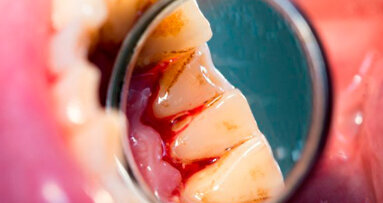 Parodontite legata a un tasso di mortalità più elevato nei pazienti con cirrosi epatica