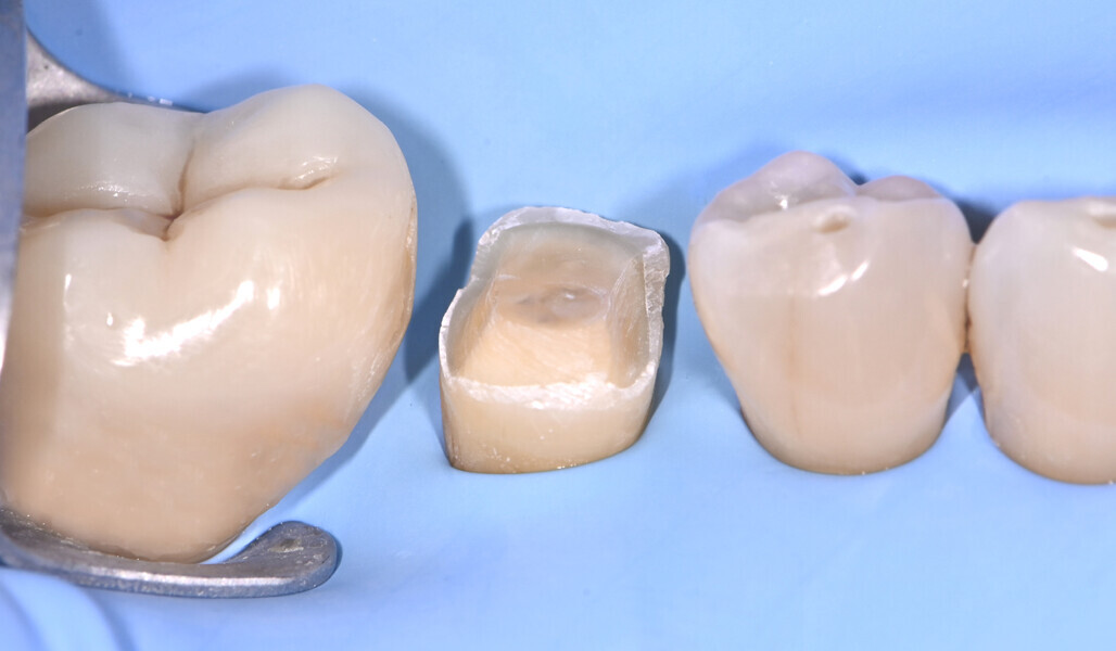 Fig. 3: Prepared tooth structure prior to immediate dentinal sealing. 