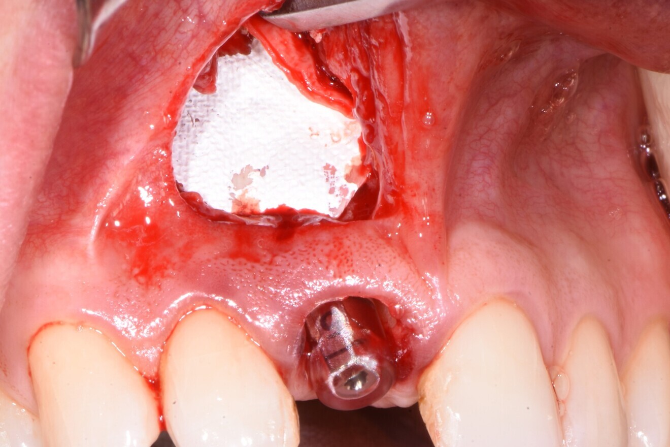 Fig. 10: Placement of an OSSIX Plus collagen barrier membrane.