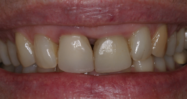 Gestione estetica degli incisivi centrali mascellari adiacenti