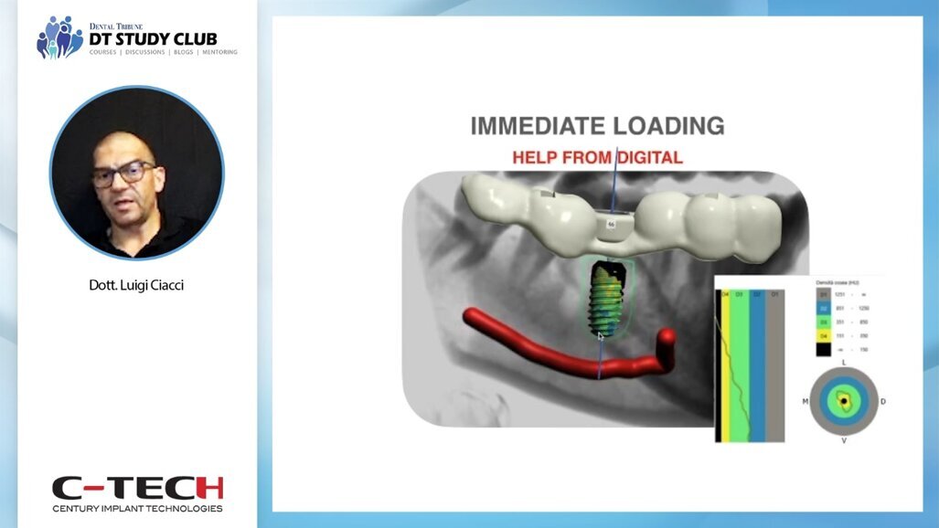 Pianificazione digitale e chirurgia guidata: flusso di lavoro e suggerimenti eseguirle al meglio