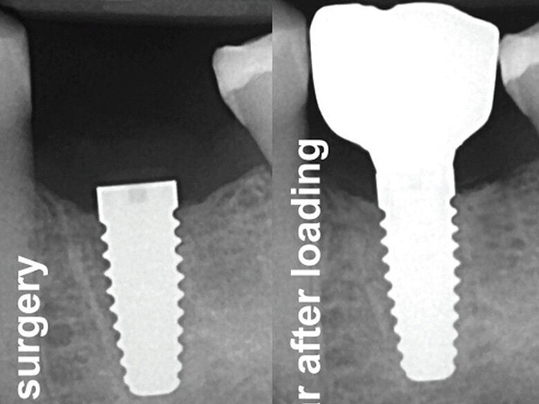 Fig. 13: X-ray control after surgery and one year post-loading. (Photo: Jens Tartsch, DMD)