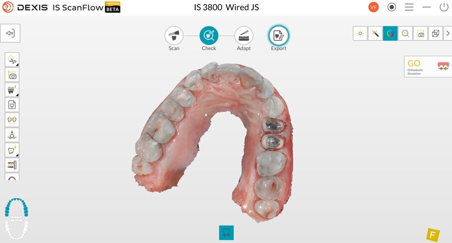 Figg. 4a–c: Impronte digitali dei premolari realizzate con lo scanner intraorale DEXIS IS 3800.