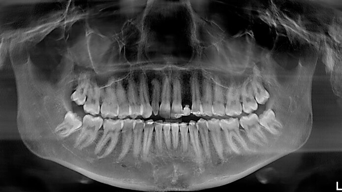 Gestione multidisciplinare di paziente con agenesia