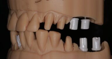 Indywidualne łączniki hybrydowe tytanowo-cyrkonowe – obserwacje 3-letnie