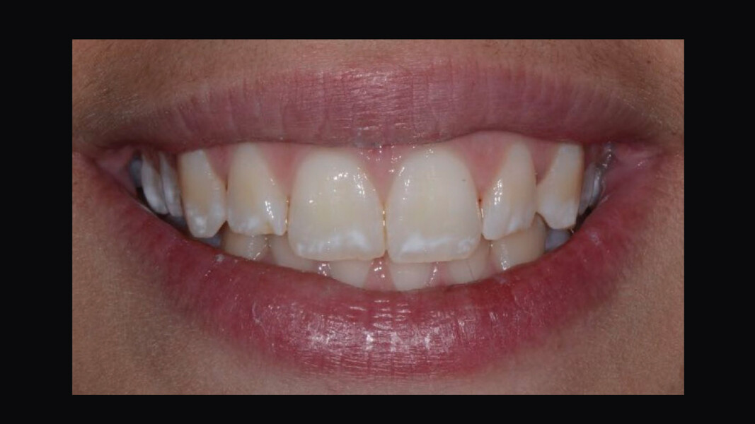 Fig. 14 - Fluorosi TF2 in paziente di 17 anni. 