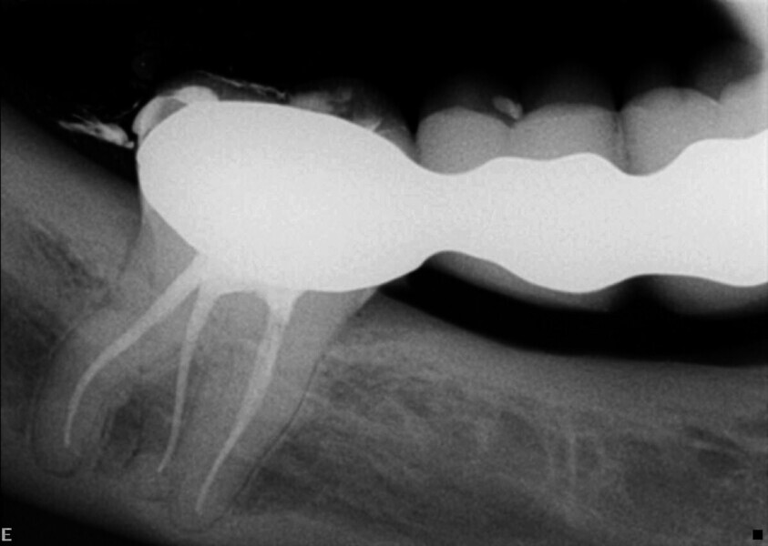Fig. 16 : Radiographie prise immédiatement après le traitement.