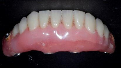 Estetyczna i funkcjonalna rehabilitacja