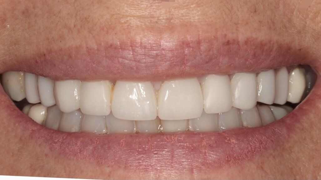 Er:YAG laser-assisted removal and recementation of a malpositioned lithium disilicate veneer