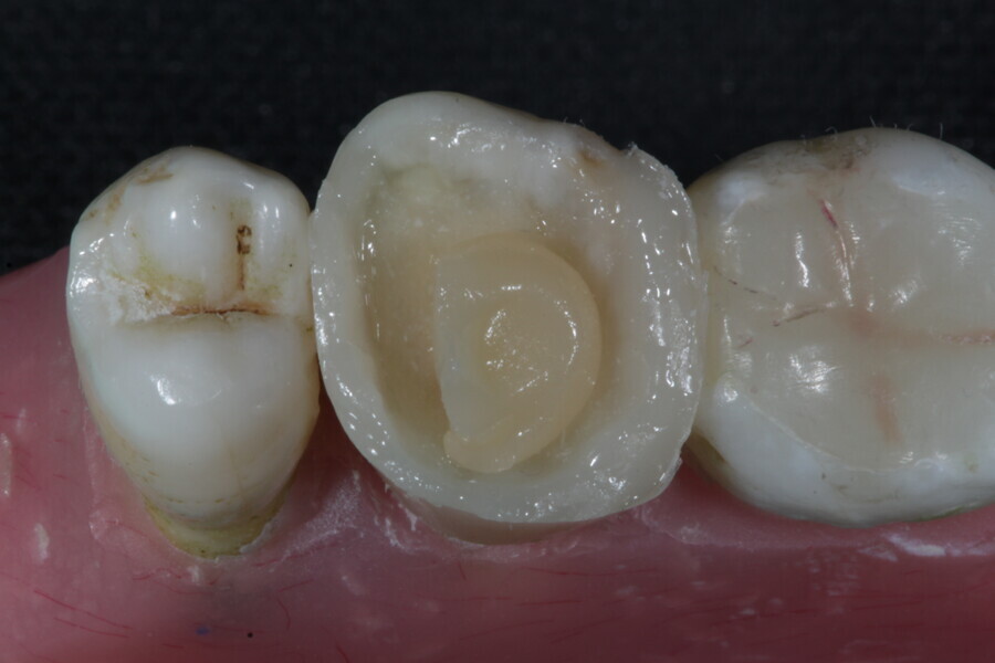 Fig. 42a: A layer of a fibre-reinforced flowable composite (Fibrafill FLOW) is applied over the membrane cube.