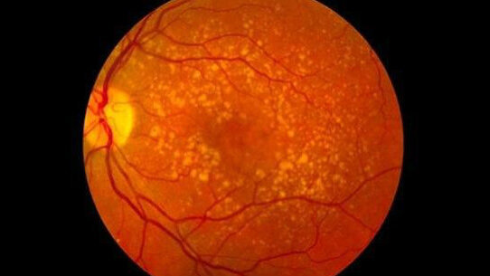 Ricercatori scoprono una possibile connessione tra cecità e perdita dei denti nei maschi