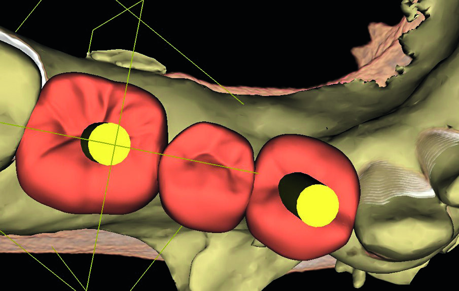 Prosthetic alignment of the implant in planning.