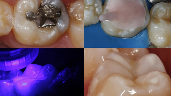 Restauración con resina compuesta usando una matriz oclusal