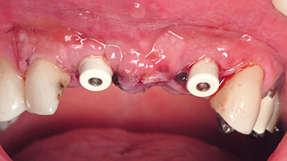 Primaire stabiliteit en osseo-integratie in beschadigde esthetische gebieden