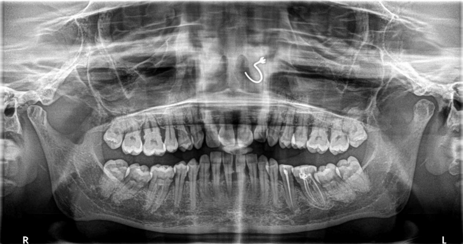 Fig. 1a: Pre-op OPG of patient showing bone loss, intra bony defects.