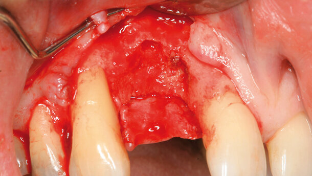 Traitement implantaire de sites édentés