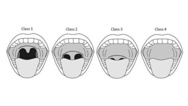 Trattamento dei disturbi del sonno con Laser Er:YAG Fotona