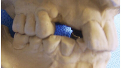 Lom implantata: Osvrt na fizičke mehanizme kliničkog neuspjeha