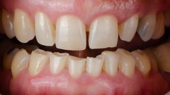 Early diagnosis is key: GC Dental Campus webinar to discuss direct restorations for tooth wear