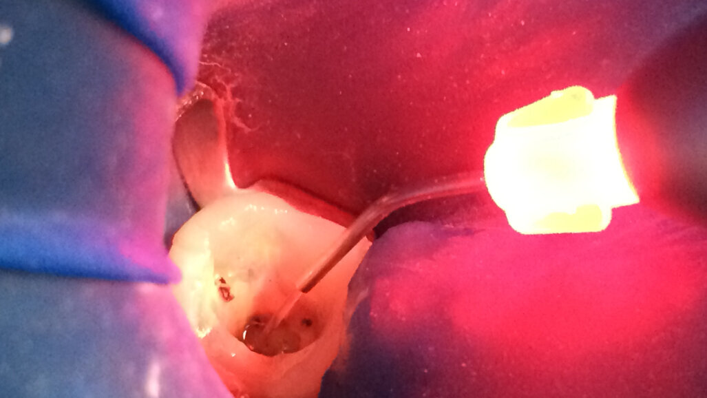 El efecto antibacteriano del láser en endodoncia