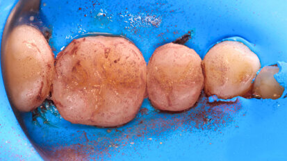 Fig. 3: During polishing without water cooling, fragments of the rubber remain on the composite surface.