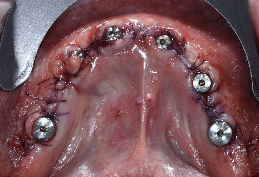 Fig. 11 - Sutura e viti di guarigione.