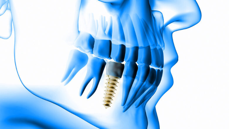 DZOI lädt zum Curriculum Implantologie 2020