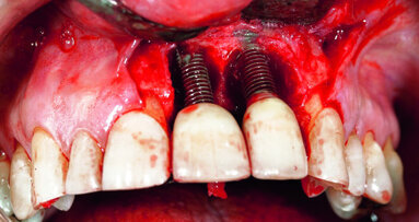 Peri-implantitis therapy - Using resorbable bone replacement material