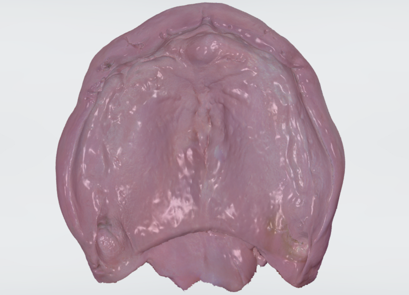 Fig. 13: Scanned maxillary denture with functional impression in situ.