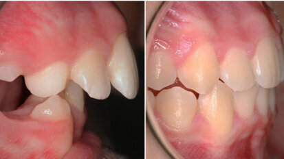 Pre-orthodontic options for 21st-century parents