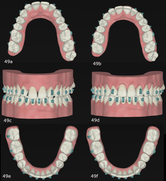 Figs. 49a–f: Final planned occlusion after the second phase of aligner treatment in FAS OcclusalDesign.