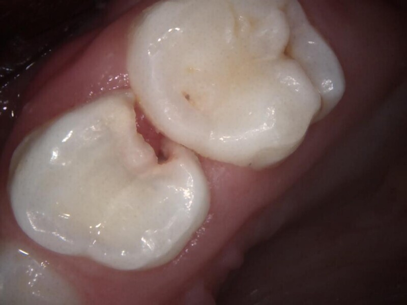 Fig. 19 : Situation initiale. Carie interproximale.