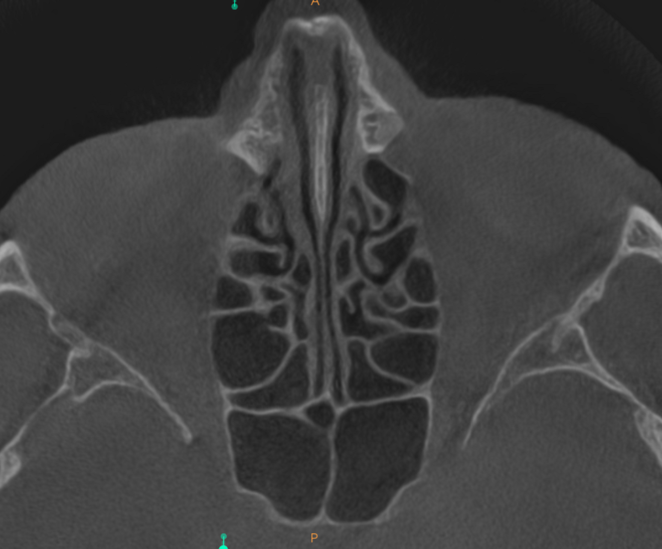 Fig. 9f:  Very high-level transversal cross-section of the maxilla showing no sign of infection in the cavernous sinus.