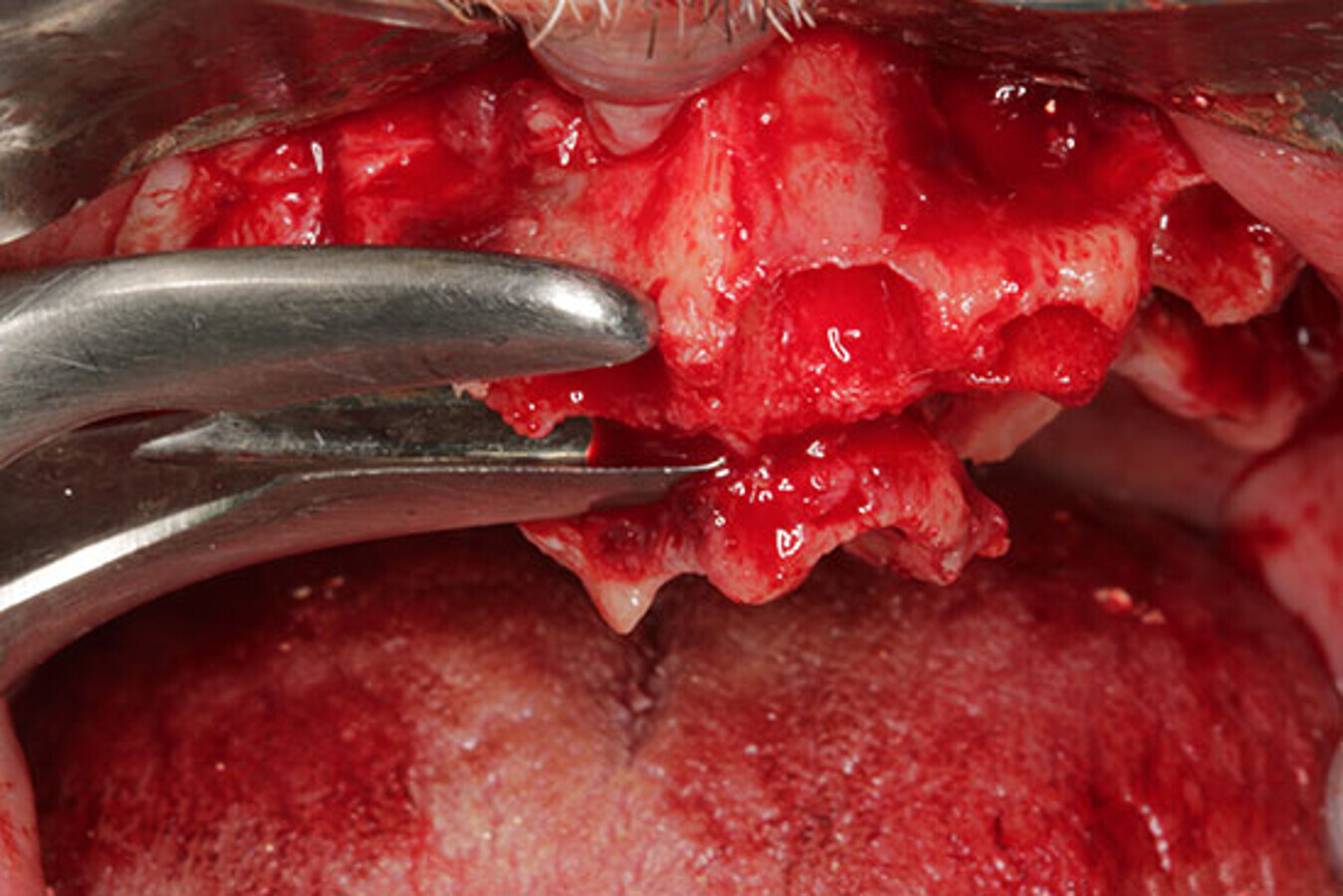 Fig. 12. RegularizaciÃ³n Ã³sea con pinza gubia para la obtenciÃ³n de hueso autÃ³logo.