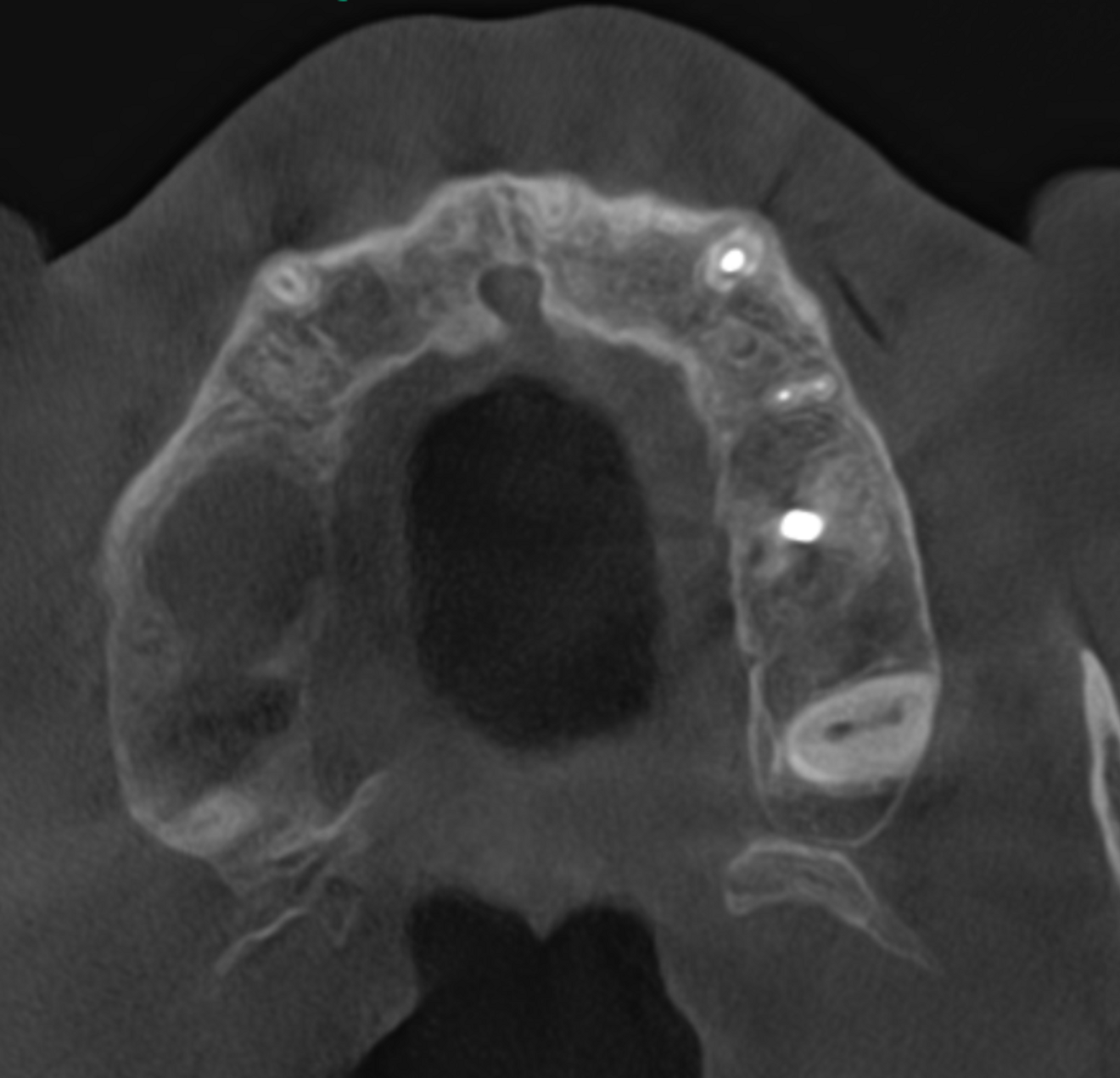 Fig. 5b: Low-level transversal cross-section of the maxilla showing full involvement of the maxillary sinus.