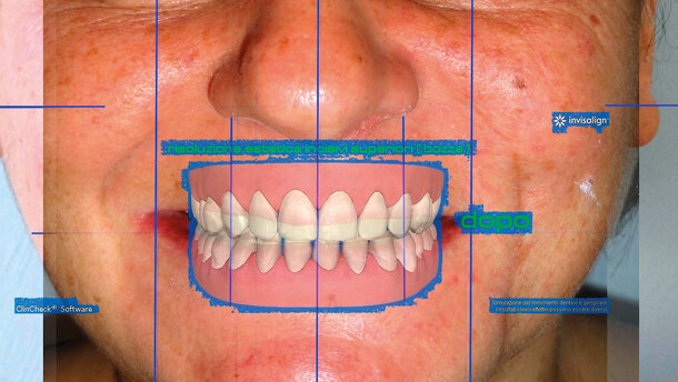 Il virtual planning tra allineamento estetico e cosmesi dentale
