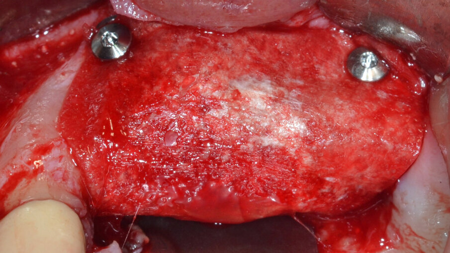 Fig. 10 - Sutura con punti a materassaio orizzontale interni intercalati a punti staccati.