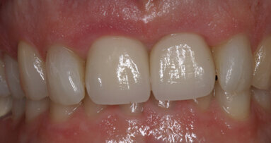 Esthetic management of adjacent maxillary central incisors: Extraction, immediate placement and immediate provisionalization