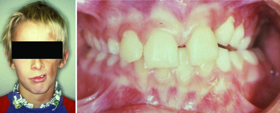 Figure 6. A 10-year-old boy with dermatomyositis creating a soft tissue tonicity imbalance (a) and resulting in a unilateral posterior crossbite (b).