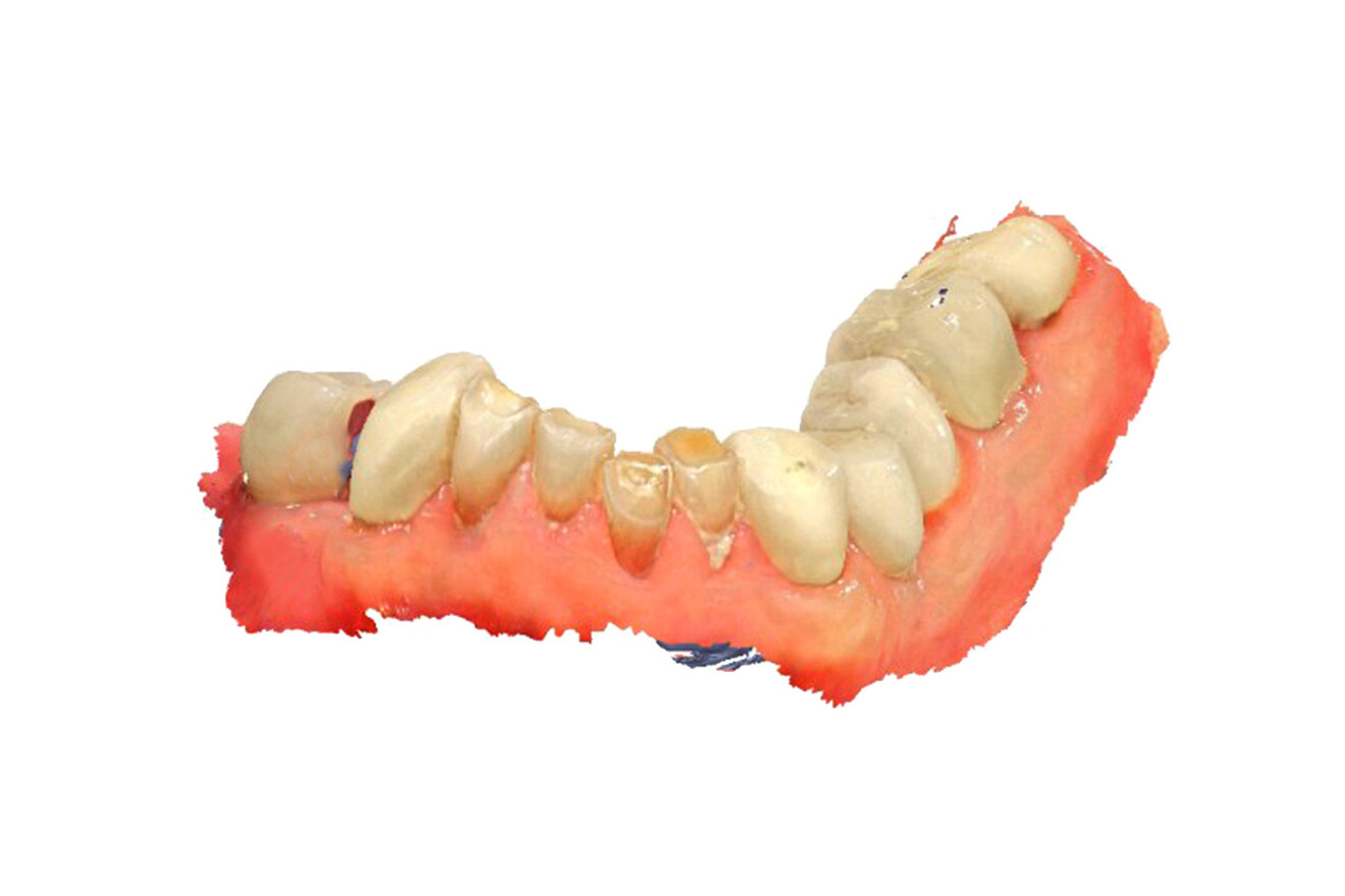 Fig. 3e: Oblique frontal view of the mandibular arch.