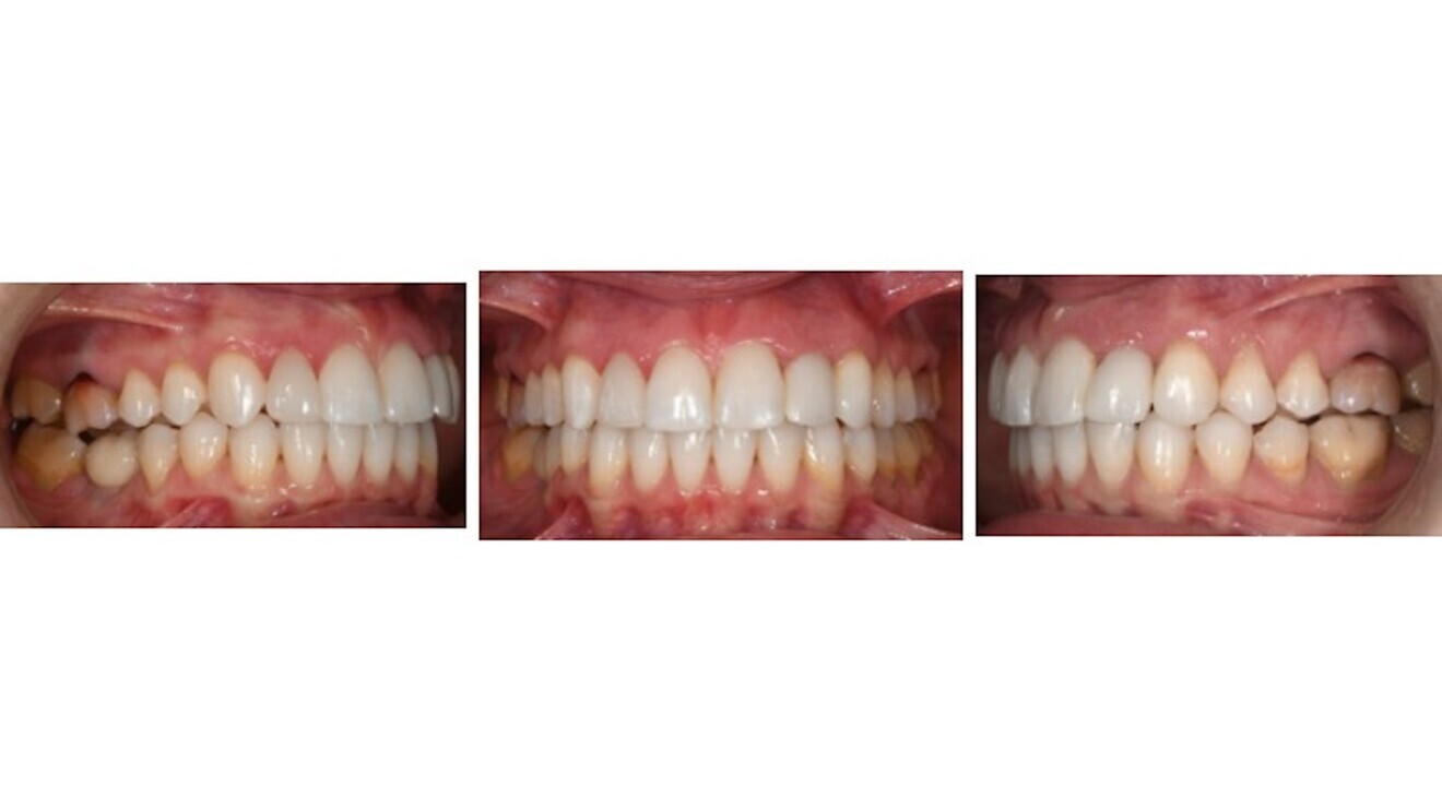 Figs. 12a–c: Final latera and frontal intra-oral photographs.