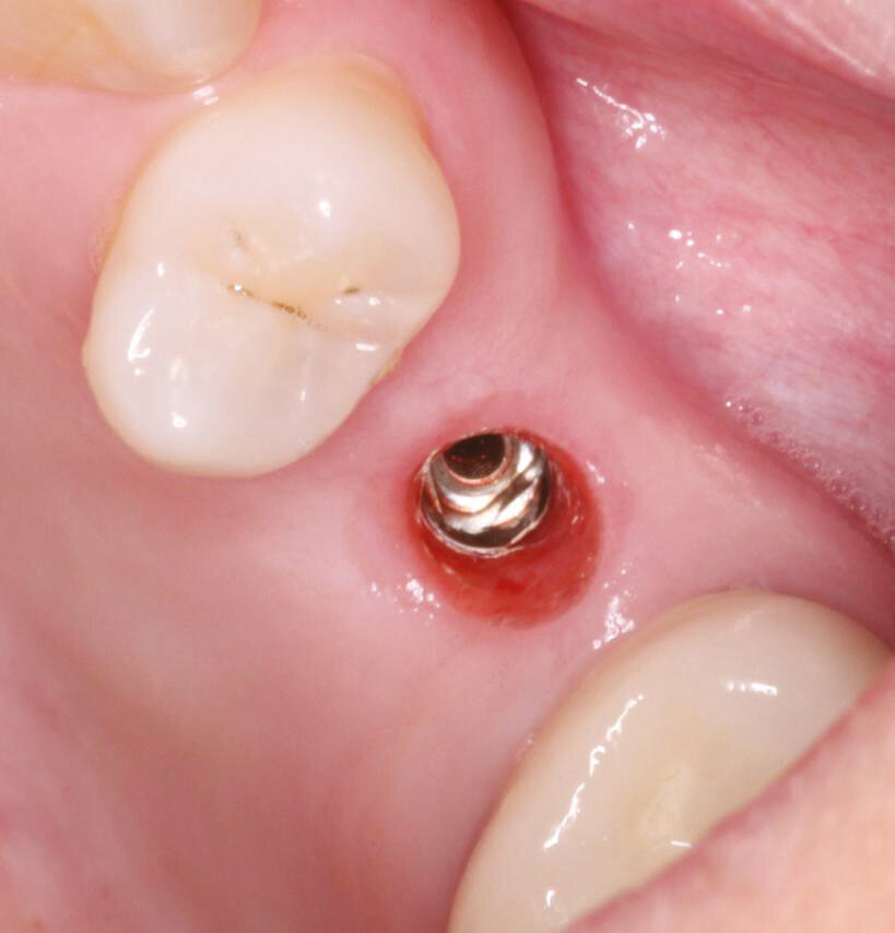Fig.13: Heal check and Healing cap removal – note the proper tissue emergence profile and excellent health.