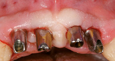 Massima estetica nel mascellare anteriore compromesso dal punto di vista parodontale: impianto immediato